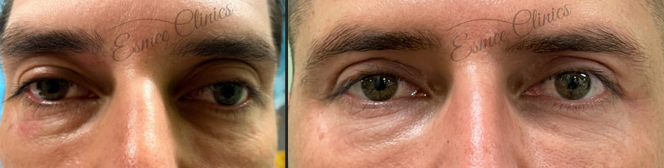 Before and After img